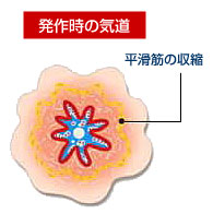 発作時の気道